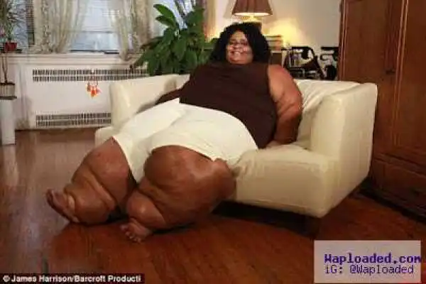 Unbelievable! See Woman Whose Legs Won’t Stop Growing Due To Chronic Disorder